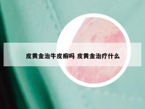 皮黄金治牛皮癣吗 皮黄金治疗什么