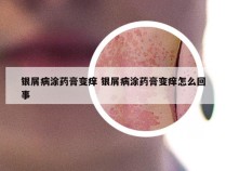 银屑病涂药膏变痒 银屑病涂药膏变痒怎么回事