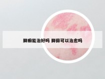 脚癣能治好吗 脚藓可以治愈吗