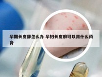 孕期长皮藓怎么办 孕妇长皮癣可以用什么药膏