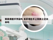 银屑病握手传染吗 银屑病在手上和脚上还会串吗