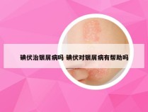 碘伏治银屑病吗 碘伏对银屑病有帮助吗