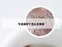 牛皮癣好了怎么去黑斑