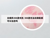 白癜风308激光机 308激光治白颠疯病可以治愈吗