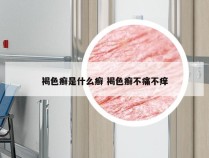 褐色癣是什么癣 褐色癣不痛不痒