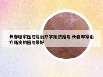 长春哪家医院能治疗掌跖脓疱病 长春哪家治疗跖疣的医院最好