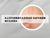 头上长牛皮癣用什么洗发水好 头皮牛皮肤癣用什么洗发水