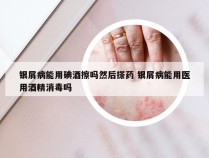 银屑病能用碘酒擦吗然后搽药 银屑病能用医用酒精消毒吗