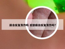 藓会反复发作吗 皮肤癣会反复发作吗?