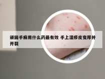 顽固手癣用什么药最有效 手上湿疹皮变厚并开裂