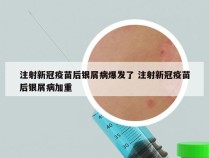 注射新冠疫苗后银屑病爆发了 注射新冠疫苗后银屑病加重