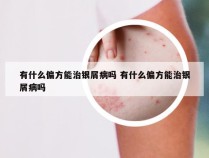 有什么偏方能治银屑病吗 有什么偏方能治银屑病吗