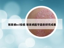 银屑病sci投稿 银屑病医学最新研究成果