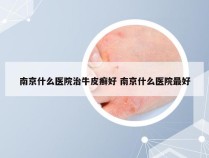 南京什么医院治牛皮癣好 南京什么医院最好