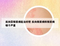 反向型银屑病能治好麽 反向银屑病和银屑病哪个严重