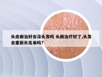 头皮癣治好会没头发吗 头癣治疗好了,头发会重新长出来吗?