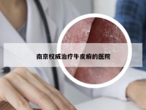 南京权威治疗牛皮癣的医院