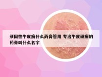 顽固性牛皮癣什么药膏管用 专治牛皮顽癣的药膏叫什么名字