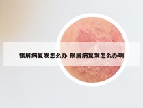 银屑病复发怎么办 银屑病复发怎么办啊