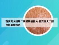 西安交大附属二院银屑病图片 西安交大二附院银屑病贴吧