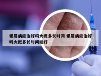 银屑病能治好吗大概多长时间 银屑病能治好吗大概多长时间能好