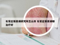 石家庄银屑病研究所怎么样 石家庄银屑病哪治疗好