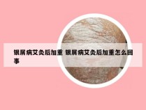 银屑病艾灸后加重 银屑病艾灸后加重怎么回事