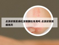 点滴状银屑病吃消银颗粒有用吗 点滴状银屑病用药