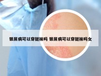 银屑病可以穿腿袜吗 银屑病可以穿腿袜吗女