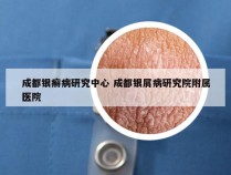 成都银癣病研究中心 成都银屑病研究院附属医院