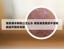 银屑病手脚裂口怎么办 银屑病发展到手掌和脚底开裂和发硬