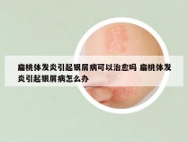 扁桃体发炎引起银屑病可以治愈吗 扁桃体发炎引起银屑病怎么办