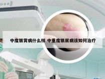 中度银霄病什么样 中重度银屑病该如何治疗