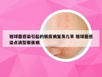 链球菌感染引起的银屑病复发几率 链球菌感染点滴型银屑病