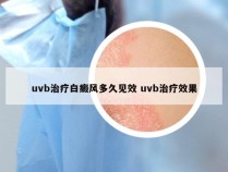 uvb治疗白癜风多久见效 uvb治疗效果