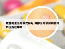 成都哪里治疗牛皮癣好 成都治疗银屑病最好的医院在哪里