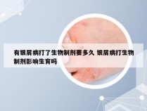 有银屑病打了生物制剂要多久 银屑病打生物制剂影响生育吗