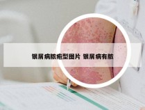 银屑病脓疱型图片 银屑病有脓