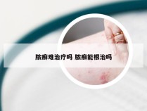 脓癣难治疗吗 脓癣能根治吗