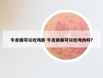 牛皮癣可以吃鸡胗 牛皮肤癣可以吃鸡肉吗?