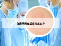 白癜风照光后变红怎么办