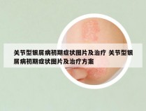 关节型银屑病初期症状图片及治疗 关节型银屑病初期症状图片及治疗方案