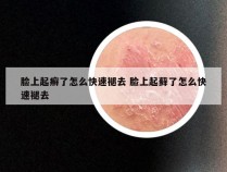 脸上起癣了怎么快速褪去 脸上起藓了怎么快速褪去