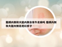 胳膊内侧和大腿内侧会有牛皮癣吗 胳膊内侧和大腿内侧出现红疹子