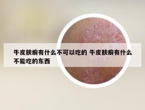 牛皮肤癣有什么不可以吃的 牛皮肤癣有什么不能吃的东西