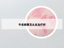 牛皮癣要怎么去治疗好