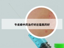 牛皮癣中药治疗好还是西药好