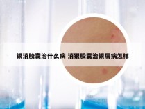 银消胶囊治什么病 消银胶囊治银屑病怎样