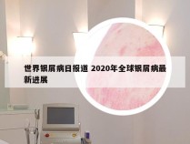 世界银屑病日报道 2020年全球银屑病最新进展