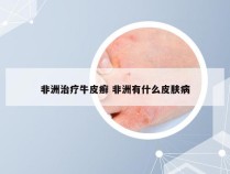 非洲治疗牛皮癣 非洲有什么皮肤病